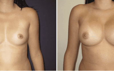 Are Breast Implants Safe?
