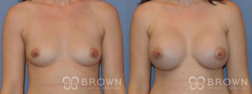 Breast Augmentation Scottsdale