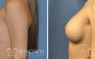 Is Breast Augmentation Best Done Above or Below the Muscle?