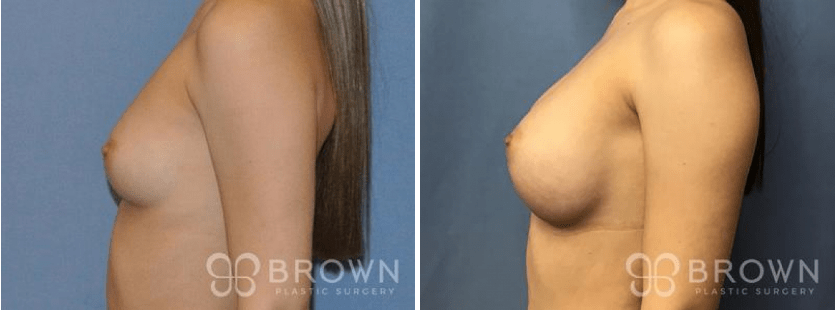 Is Breast Augmentation Best Done Above or Below the Muscle?