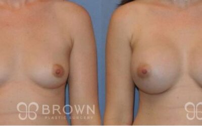 Are Breast Augmentation Results Natural Looking?