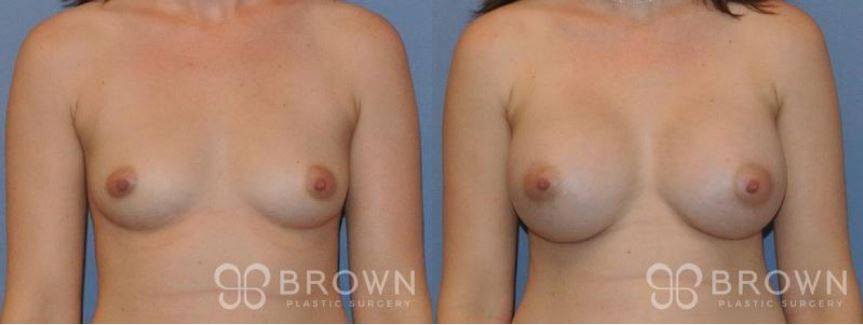 Are Breast Augmentation Results Natural Looking?