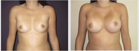 Breast Implant Scottsdale