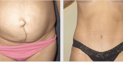 What’s the Difference Between a Tummy Tuck and Liposuction?