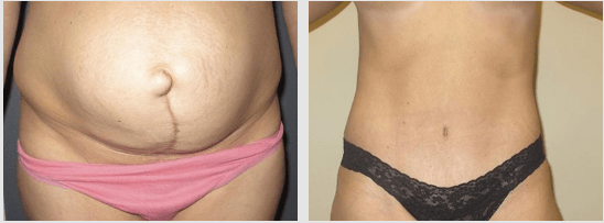 What’s the Difference Between a Tummy Tuck and Liposuction?