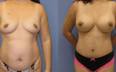 What Procedures Make Up a Mommy Makeover?