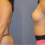 Mommy Makeover Scottsdale
