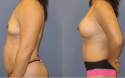How Much Mommy Makeover Cost?