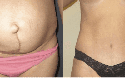 What’s the Recovery Time for a Tummy Tuck?