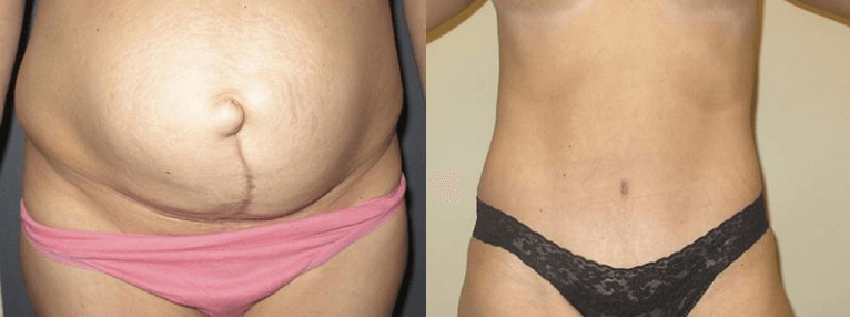 What’s the Recovery Time for a Tummy Tuck?