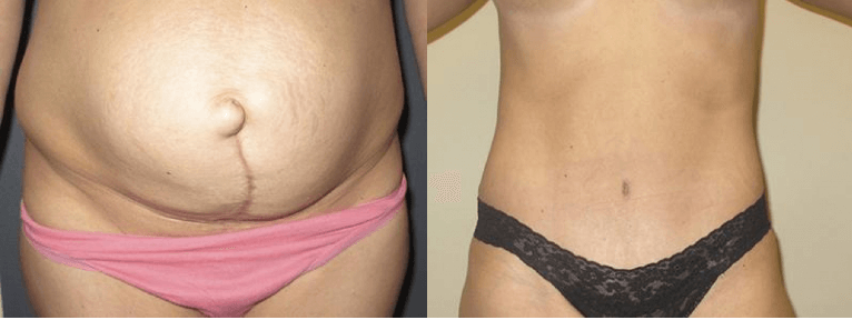 What's the Recovery Time for a Tummy Tuck? - Brown Plastic Surgery