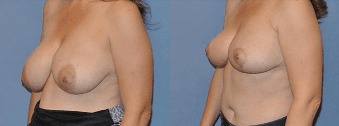 What are the Benefits of Breast Reduction?