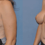 Breast Reduction Scottsdale