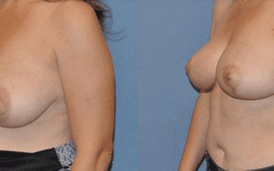 What are the Benefits of Breast Reduction?