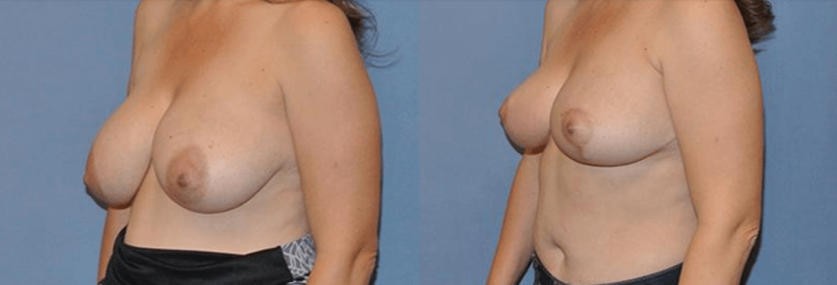 What are the Benefits of Breast Reduction?