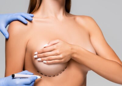 Breast Lift (Mastopexy)
