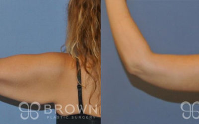 How Much Does an Arm Lift Cost?