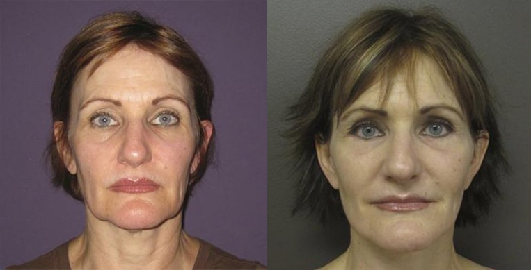 How Much Does a Facelift Cost?