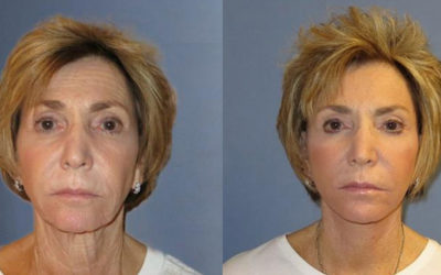 How Can I Get Rid of My Sagging Jowls?