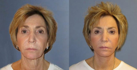 woman before and after facelift