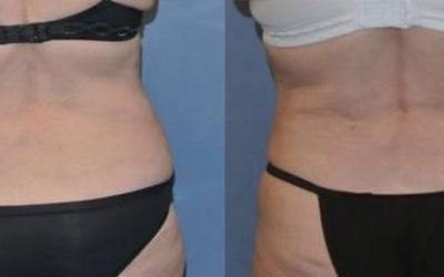 How Much Does Liposuction Cost?
