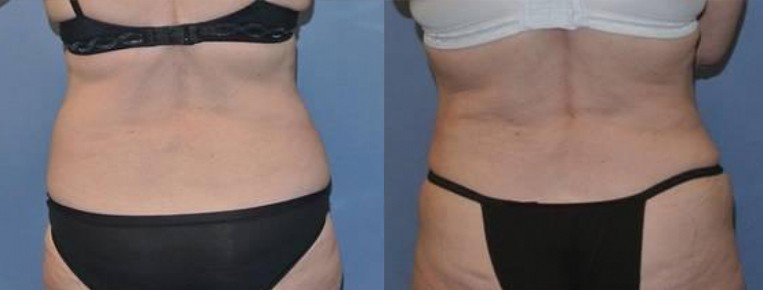 How Much Does Liposuction Cost?