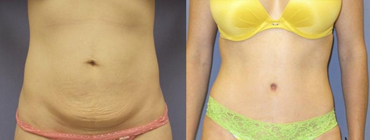 What Happens To My Belly Button During a Tummy Tuck? - Brown