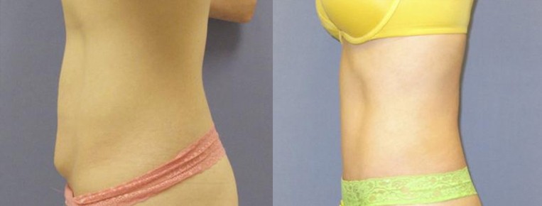 Best Tummy Tuck in Phoenix  Abdominoplasty Surgery Scottsdale