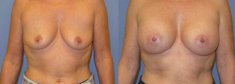 Breast Augmentation and Breast Lift: Can I Combine Them?
