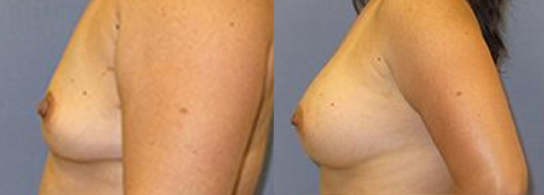 Breast Augmentation Scottsdale