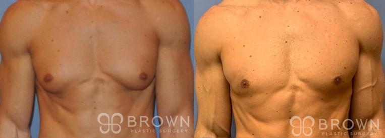Breast Augmentation Scottsdale