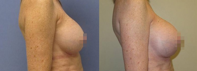 Revcase7416-3 Breast Augmentation Scottsdale