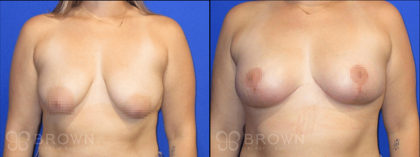 6464 Mastopexy B&A