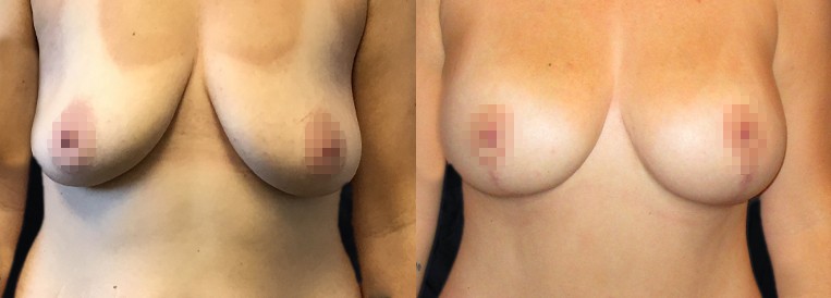 Breast Augmentation Scottsdale
