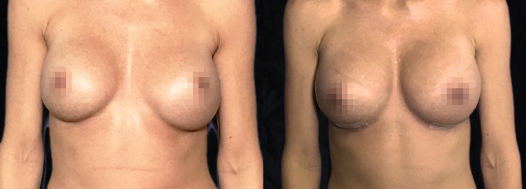 Breast Augmentation Scottsdale