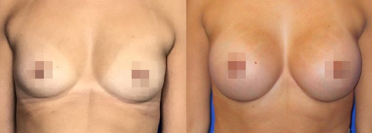 img Breast Augmentation Scottsdale