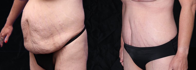 PT 10221-1 Breast Augmentation Scottsdale
