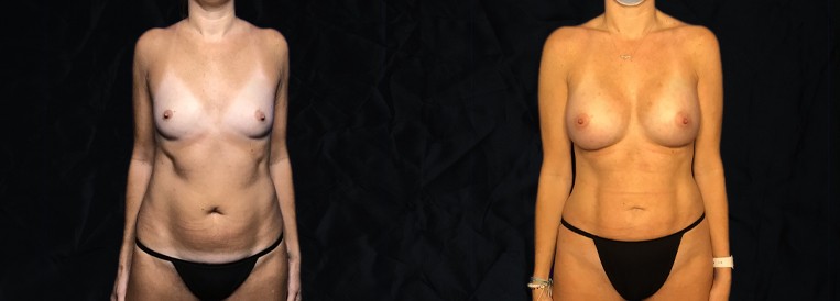 PT 3632-1 Breast Augmentation Scottsdale