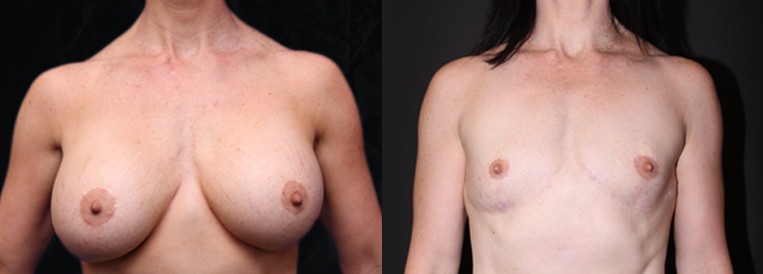 PT 4907 Breast Augmentation Scottsdale