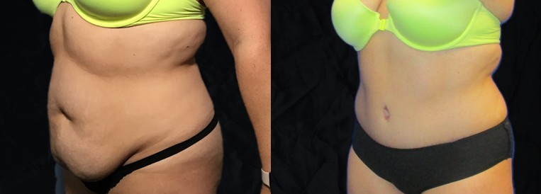PT 4970-1 Breast Augmentation Scottsdale