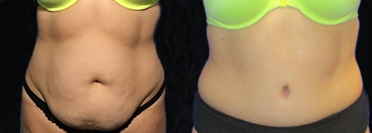 PT 4970-1 Breast Augmentation Scottsdale