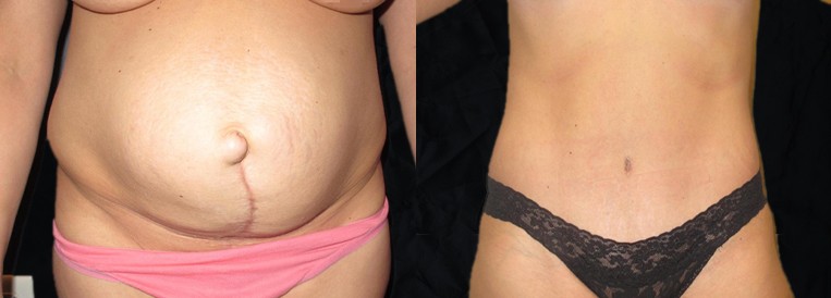 PT 551 Breast Augmentation Scottsdale