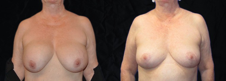 PT 5992 Breast Augmentation Scottsdale