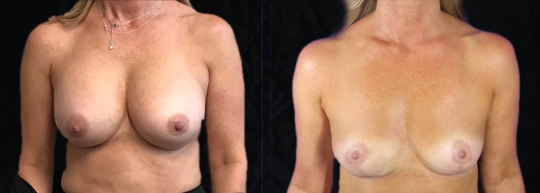 Breast Augmentation Scottsdale