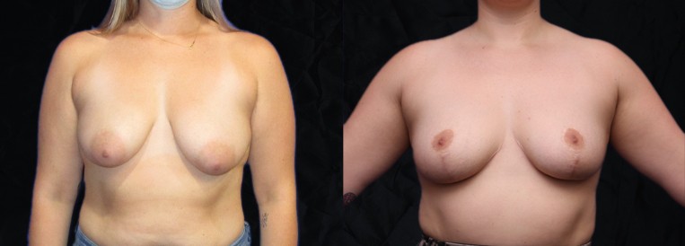 PT 6464 Breast Augmentation Scottsdale