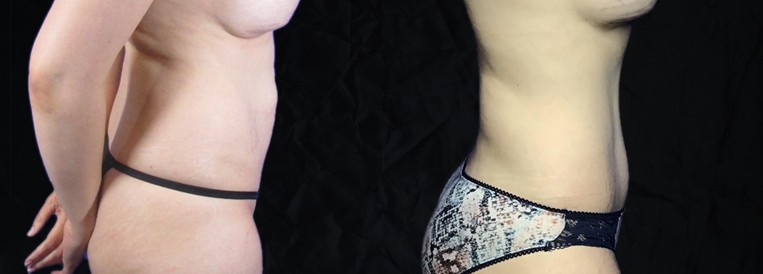 PT 6532-1 Breast Augmentation Scottsdale
