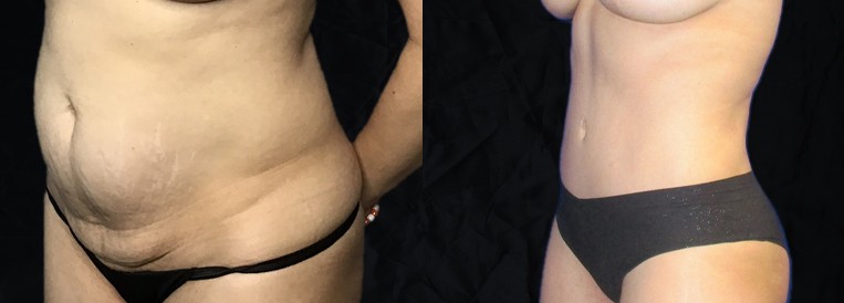 PT 6568-1 Breast Augmentation Scottsdale
