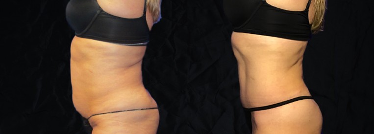 PT 7206-2 Breast Augmentation Scottsdale