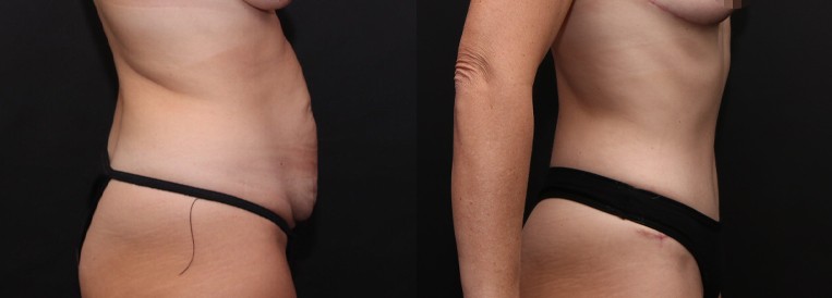 PT 7342-1 Breast Augmentation Scottsdale