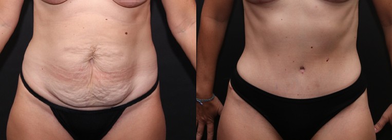 PT 7342 Breast Augmentation Scottsdale
